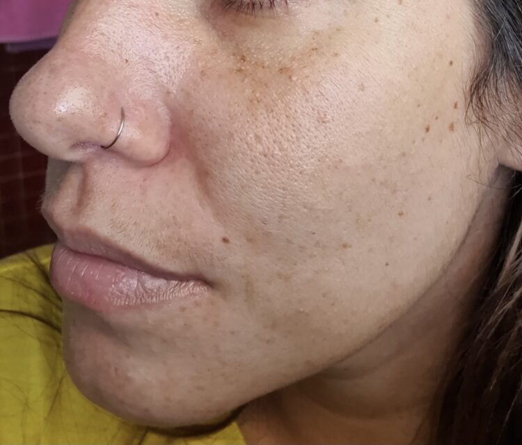 MEUS PRODUTOS DE SKIN CARE PARA O DIA - ROSTO COM ACNE